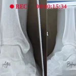 Broken Ankle in a Boot: Is It Weight Bearing and Is Travel Safe?